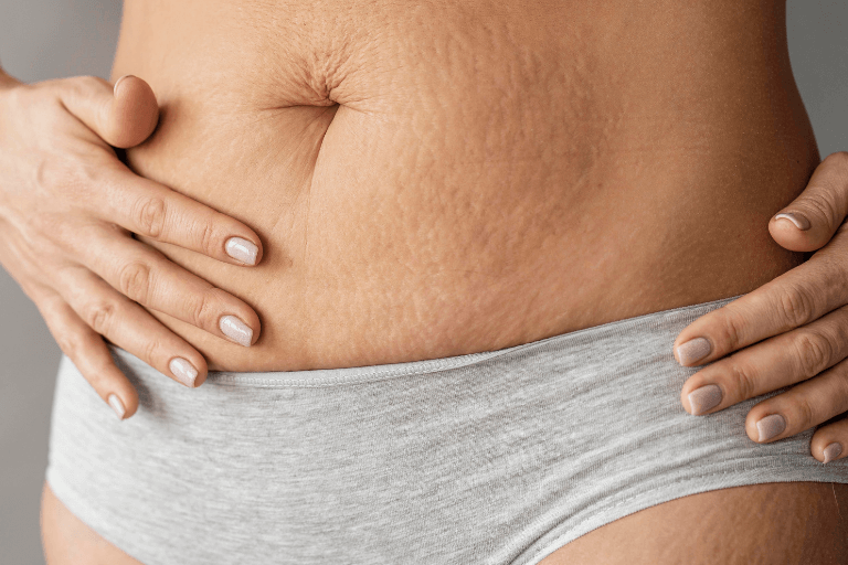 The Unbelievable Truth About Your Stretch Marks - Merindah Botanicals